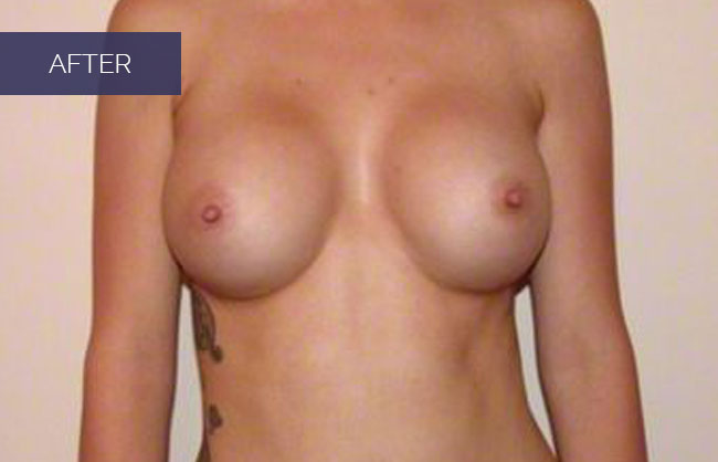 breast implant results