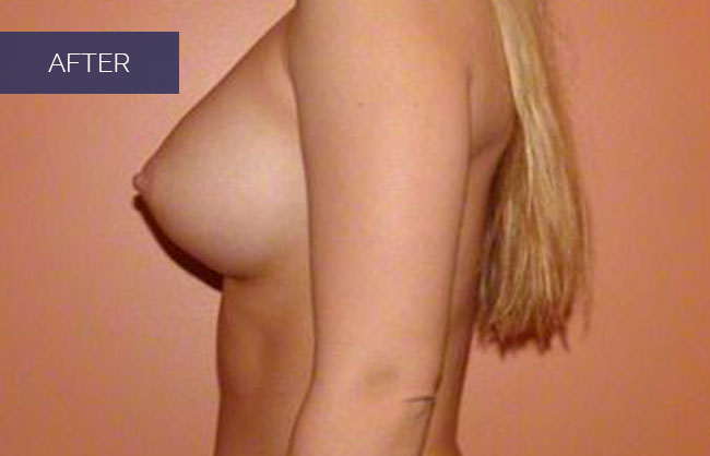 breast augmentation results in Utah 6