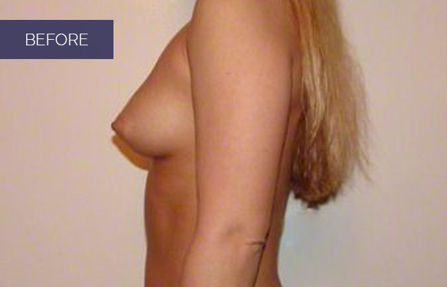 breast augmentation befor pics in Utah 6